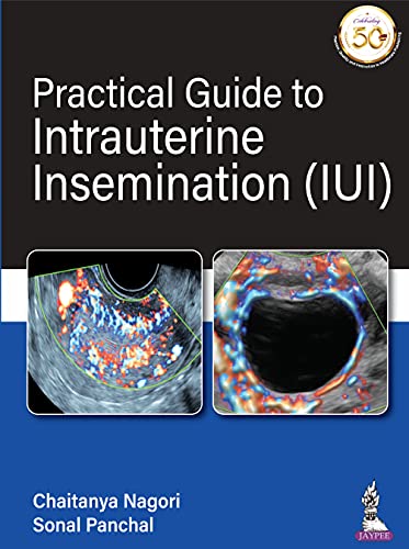 Practical Guide To Intrauterine Insemination (IUI)