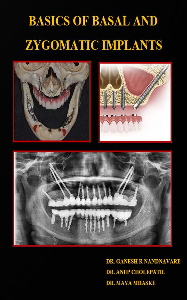 Basics of Basal and Zygomatic Implants