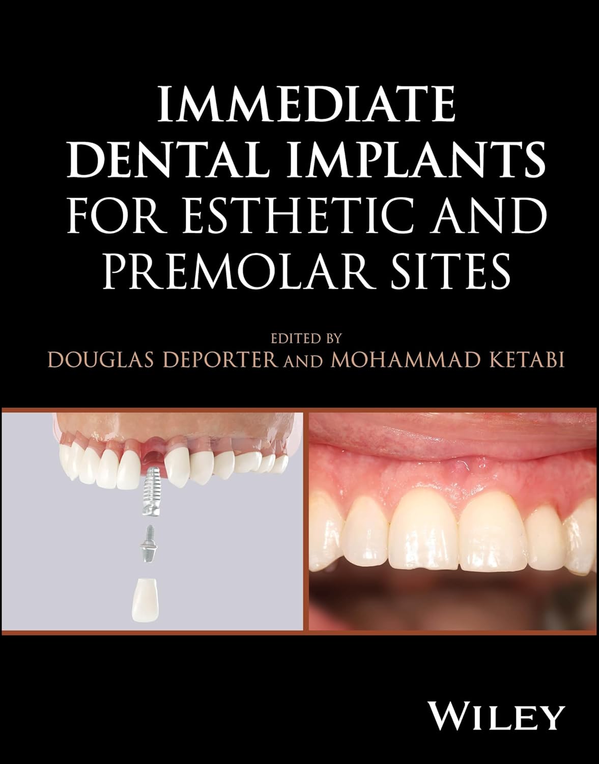 Immediate Dental Implants for Esthetic and Premolar Sites 1st Edition - 2025