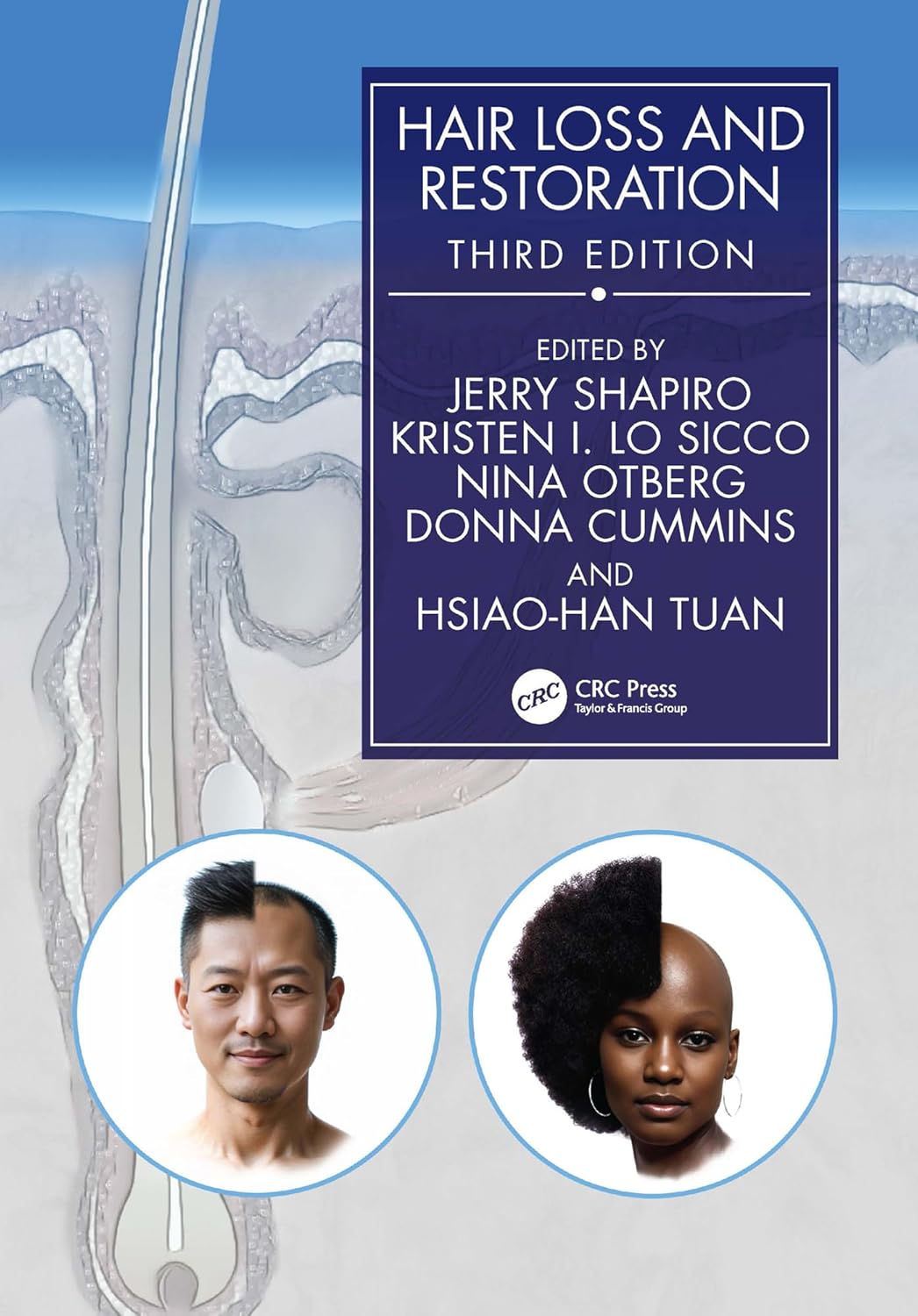 Hair Loss and Restoration, 3rd Edition