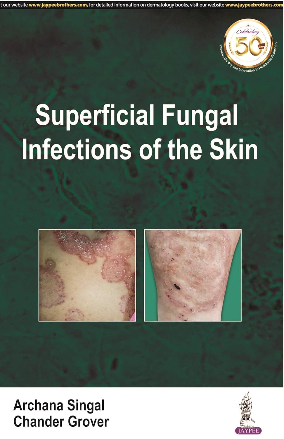 Superficial Fungal Infections of the Skin