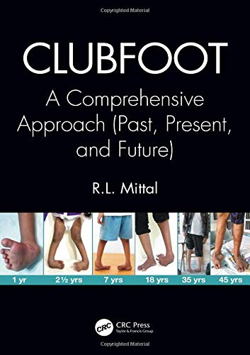 Clubfoot: A Comprehensive Approach (Past, Present, and Future) (PDF)
