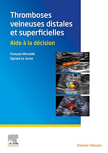 Thromboses veineuses distales et superficielles: Aide à la décision (French Edition)