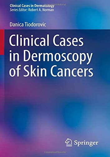 Clinical Cases in Dermoscopy of Skin Cancers (Clinical Cases in Dermatology)