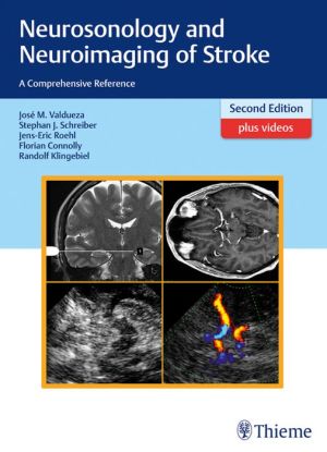 Neurosonology and Neuroimaging of Stroke: A Comprehensive Reference, 2nd Edition (PDF)