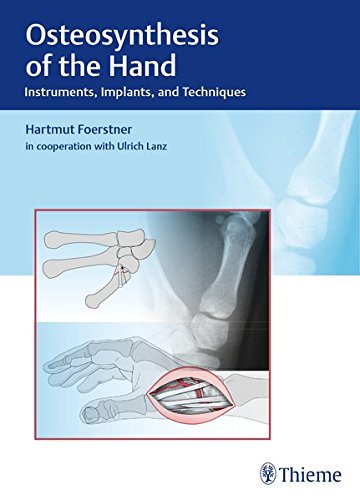 Osteosynthesis of the Hand: Instruments, Implants, and Techniques (PDF)
