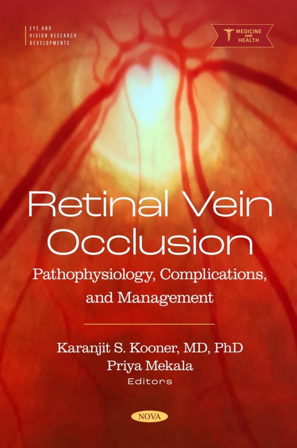 Retinal Vein Occlusion: Pathophysiology, Complications, and Management