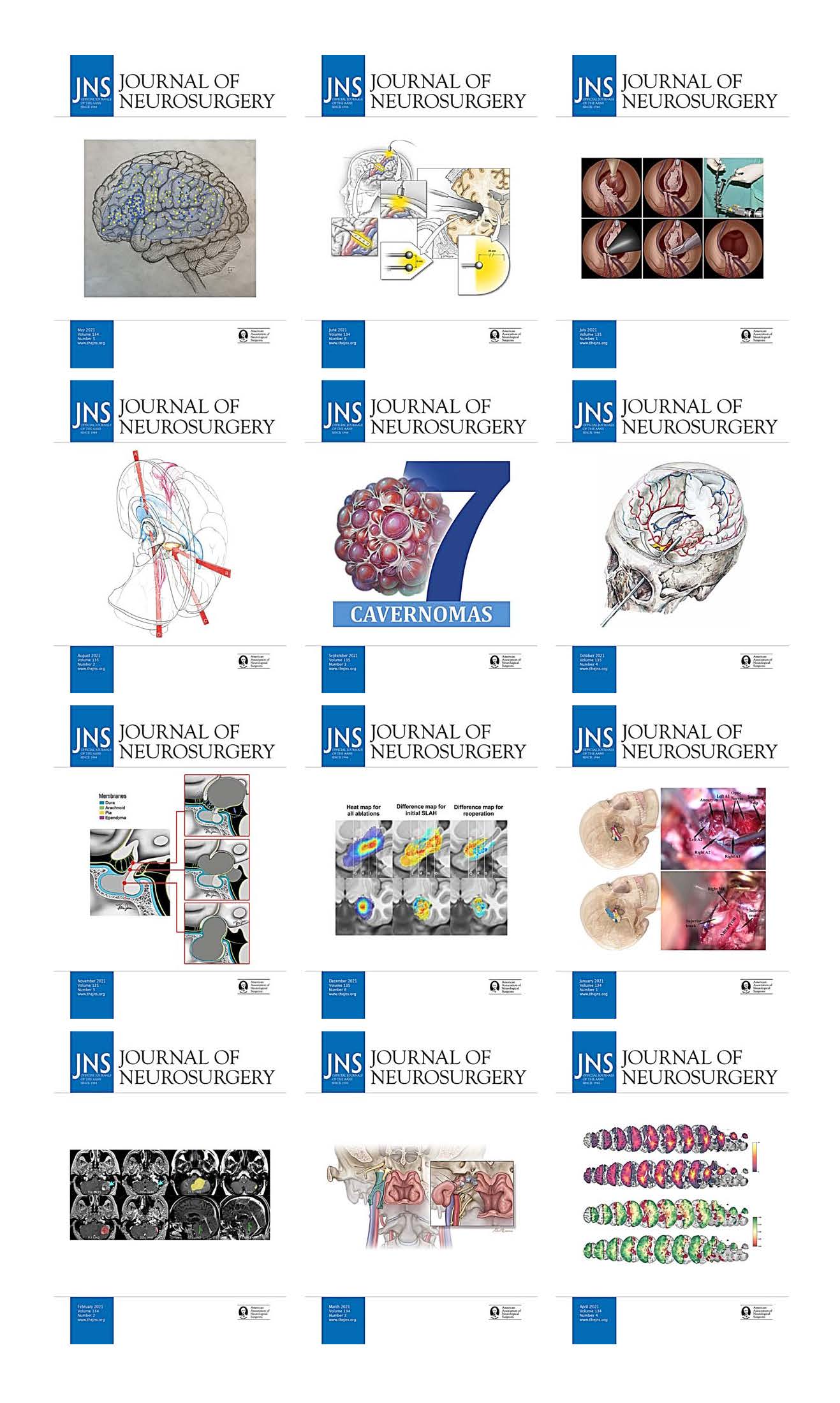 Journal of Neurosurgery 2021 Full Archives (True PDF)