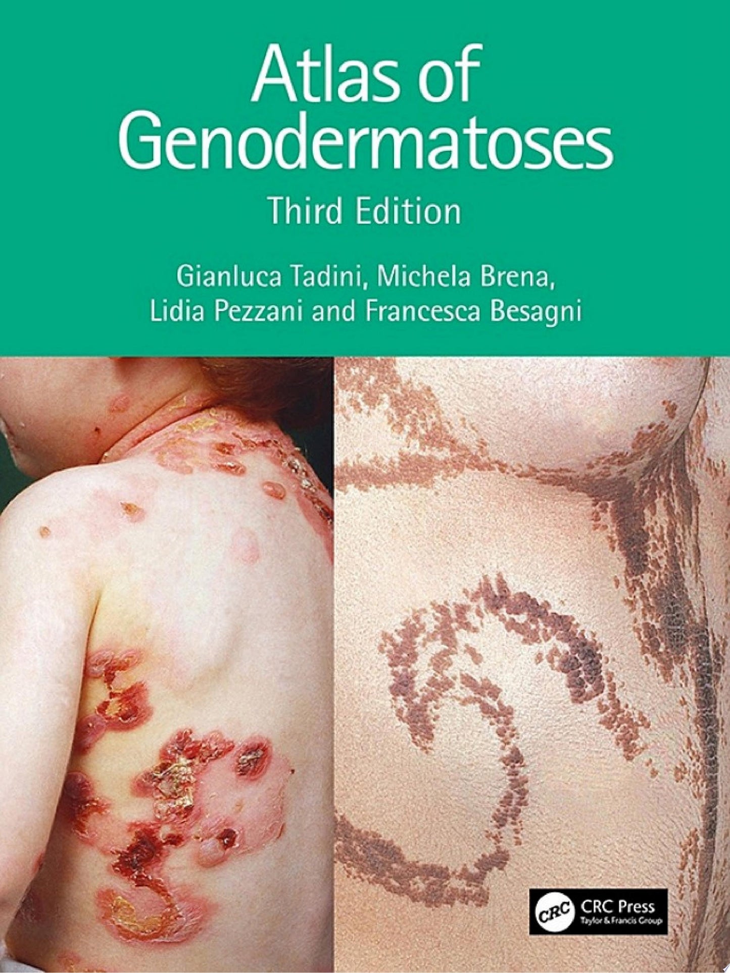 Atlas of Genodermatoses, 3rd Edition