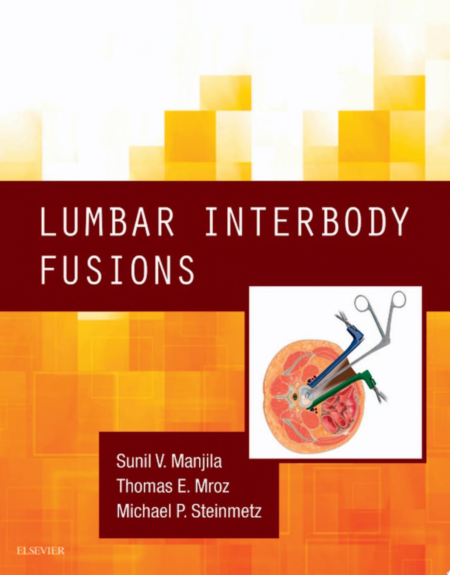 Lumbar Interbody Fusions (PDF)