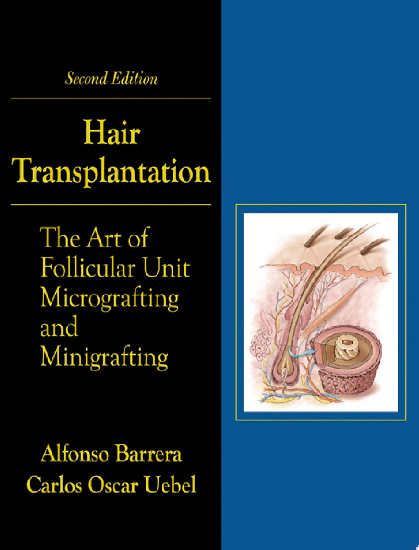 Hair Transplantation: The Art of Micrografting and Minigrafting, Second Edition