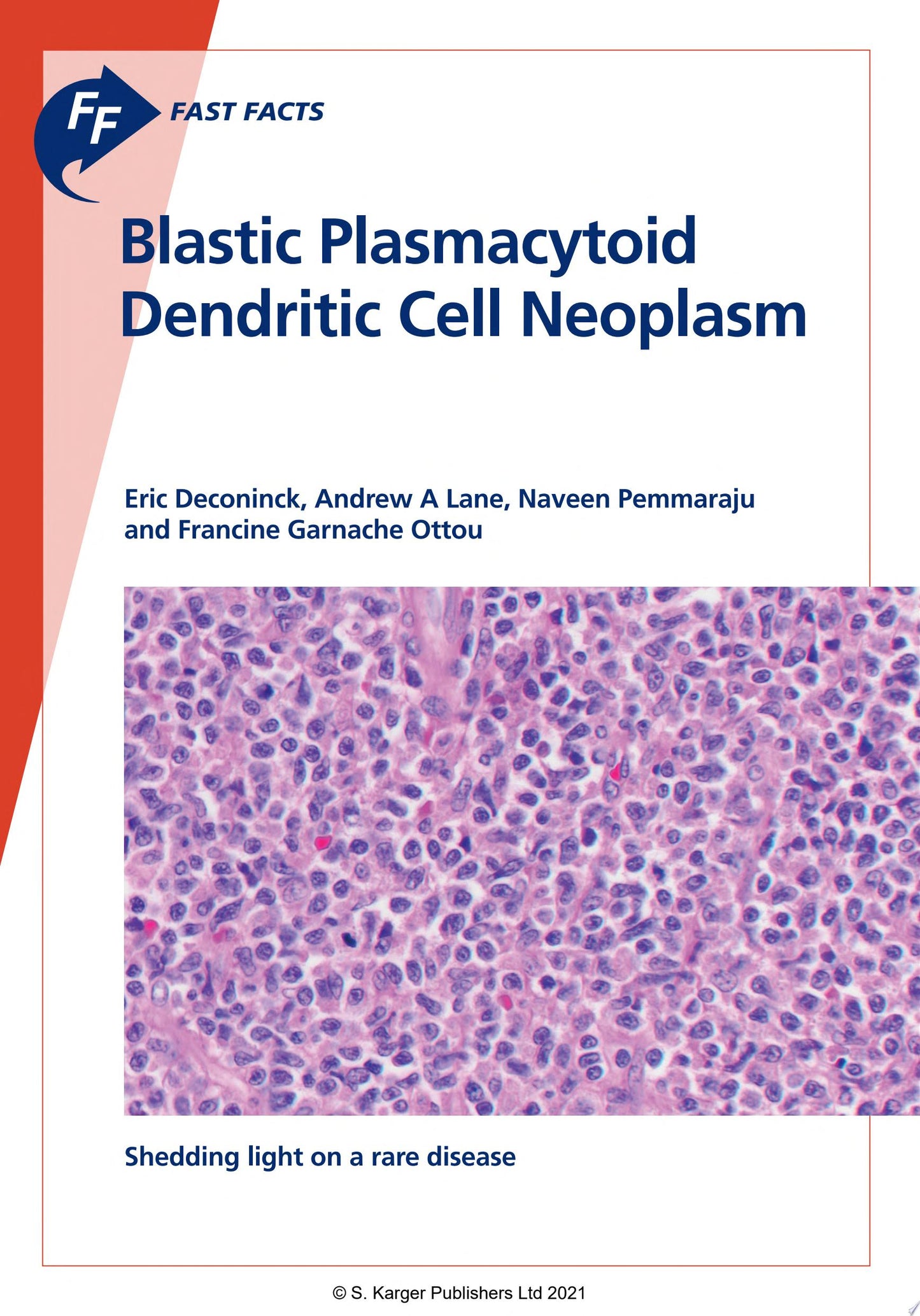 Fast Facts: Blastic Plasmacytoid Dendritic Cell Neoplasm: Shedding Light on a Rare Disease