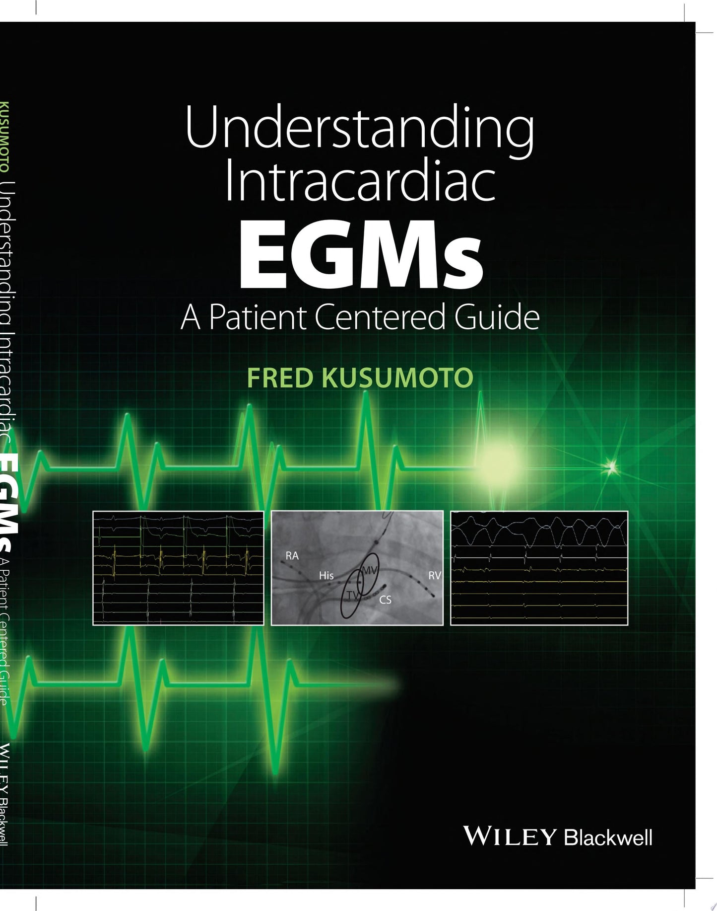 Understanding Intracardiac EGMs: A Patient Centered Guide