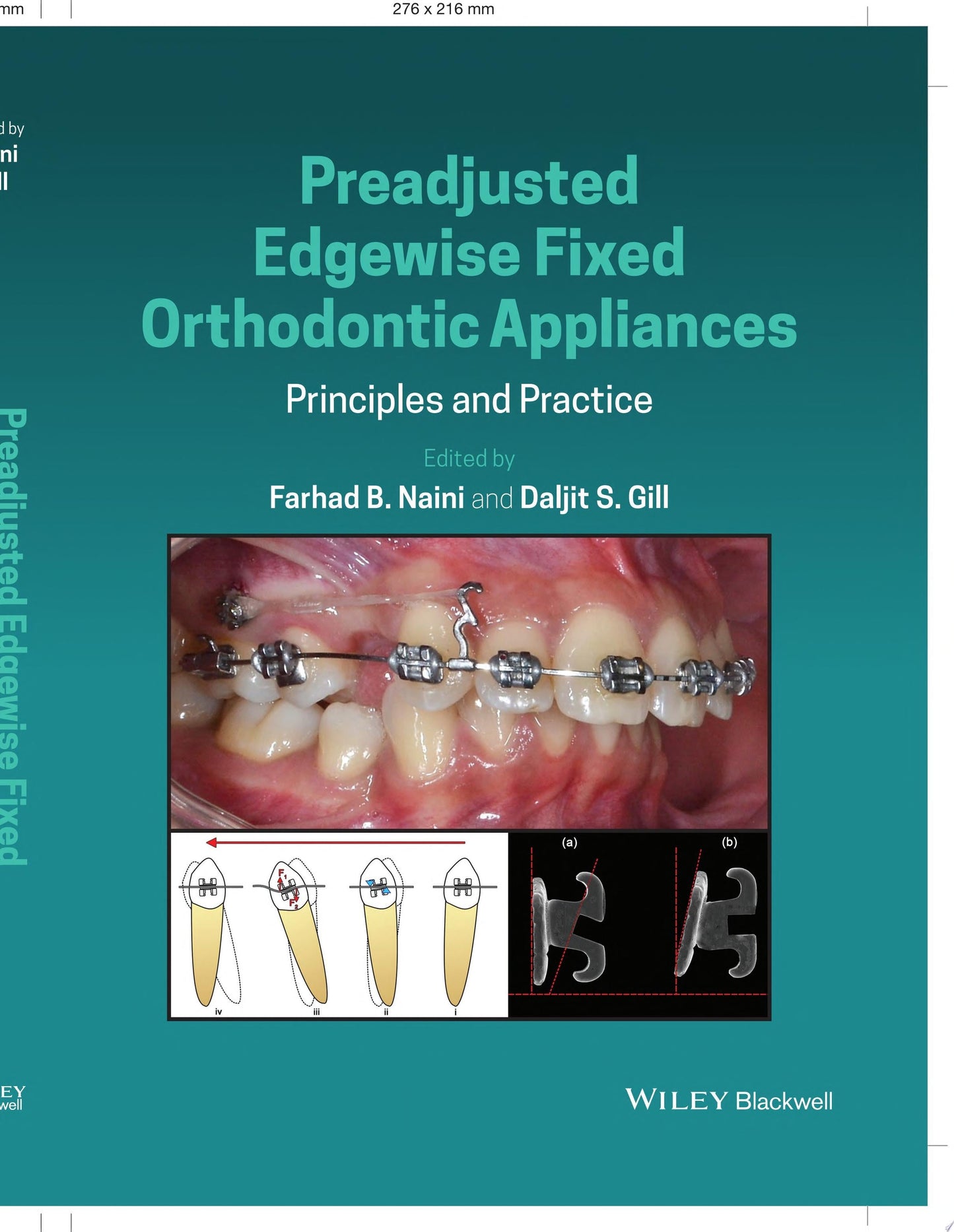 Preadjusted Edgewise Fixed Orthodontic Appliances
