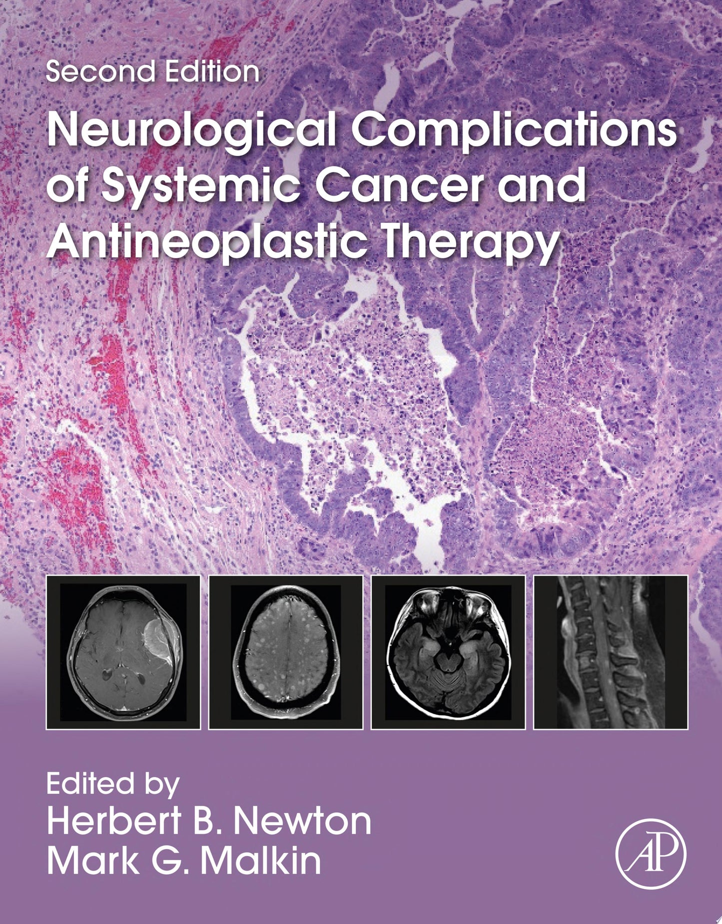 Neurological Complications of Systemic Cancer and Antineoplastic Therapy