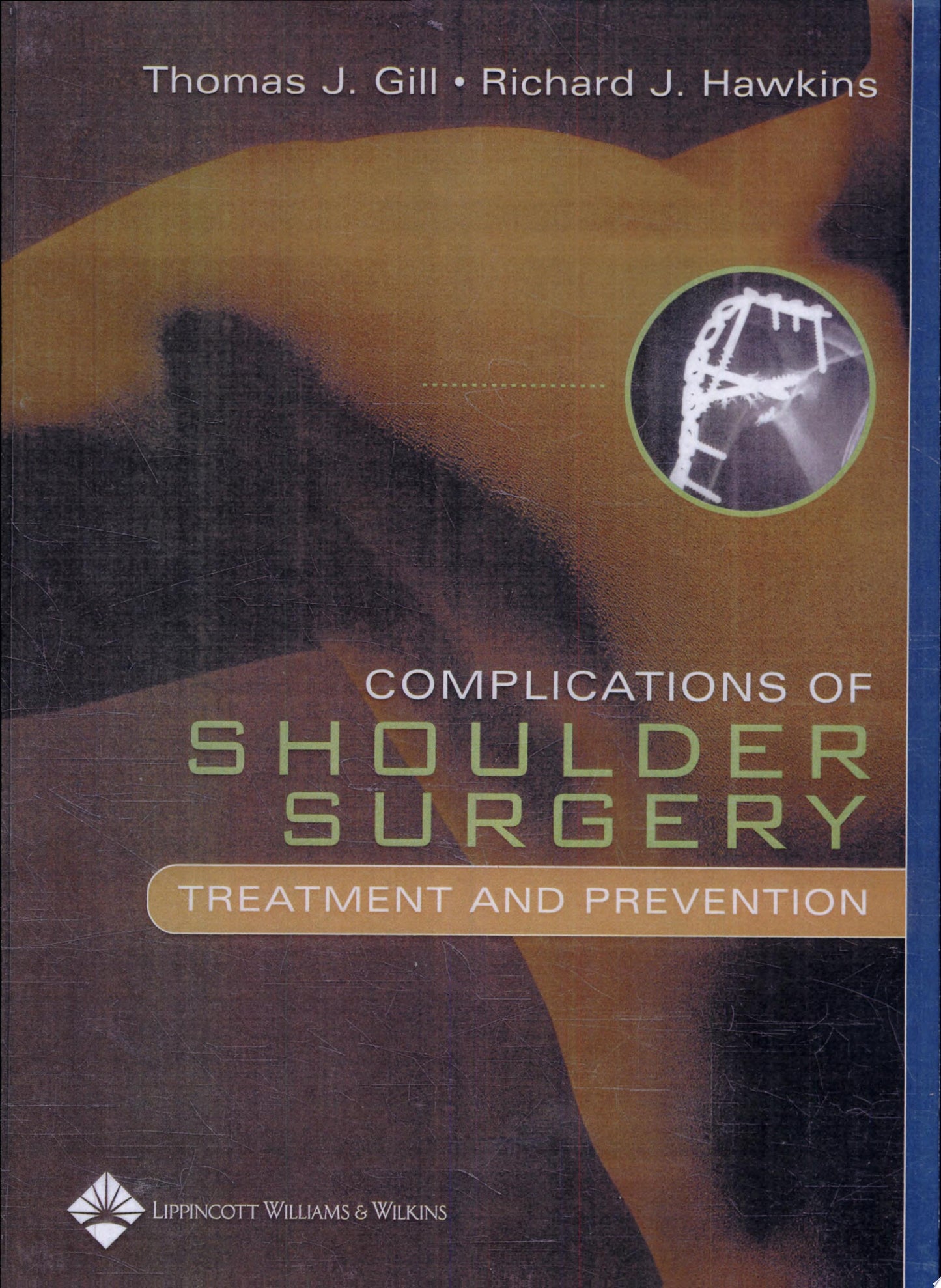 Complications of Shoulder Surgery: Treatment and Prevention