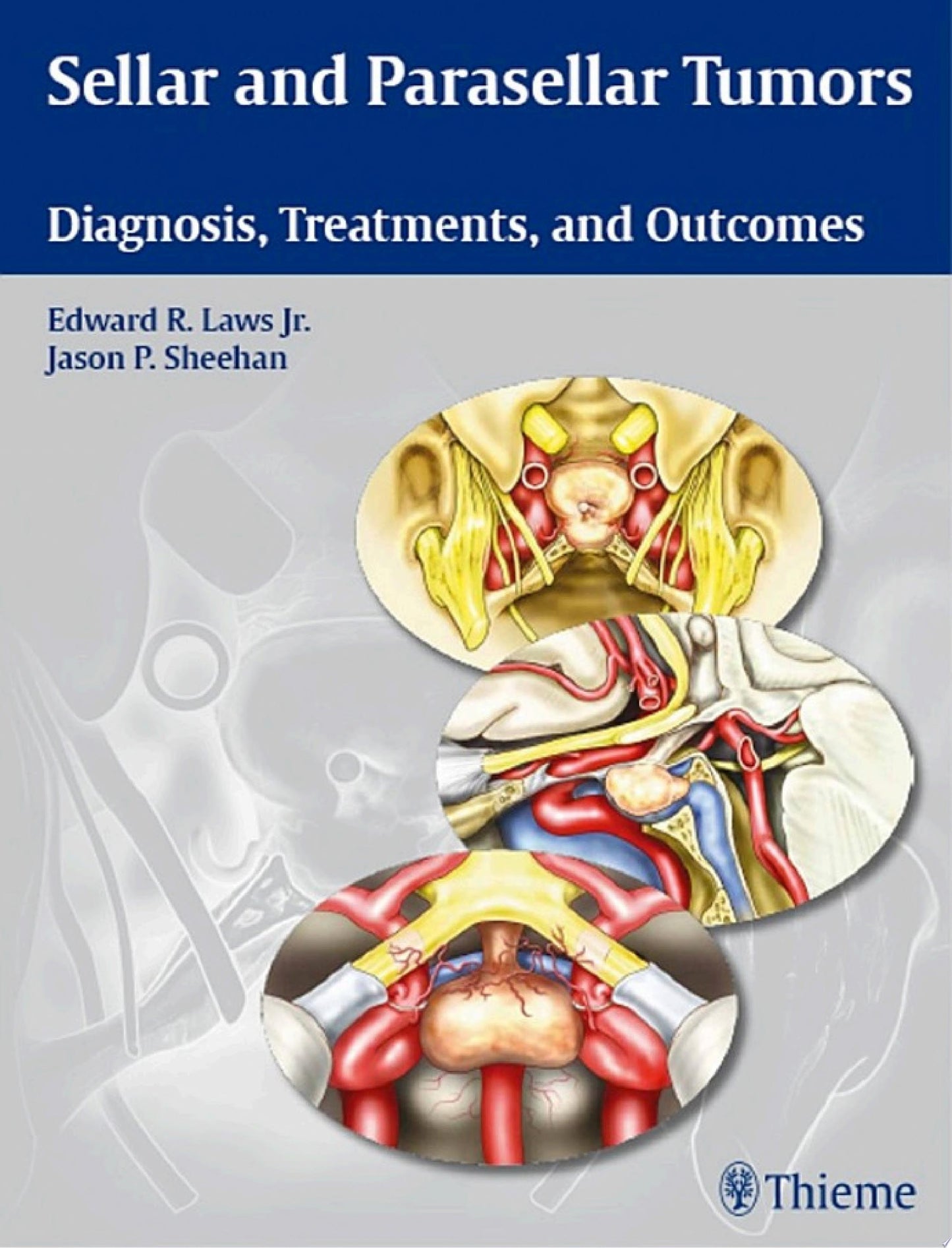 Sellar and Parasellar Tumors: Diagnosis, Treatments, and Outcomes
