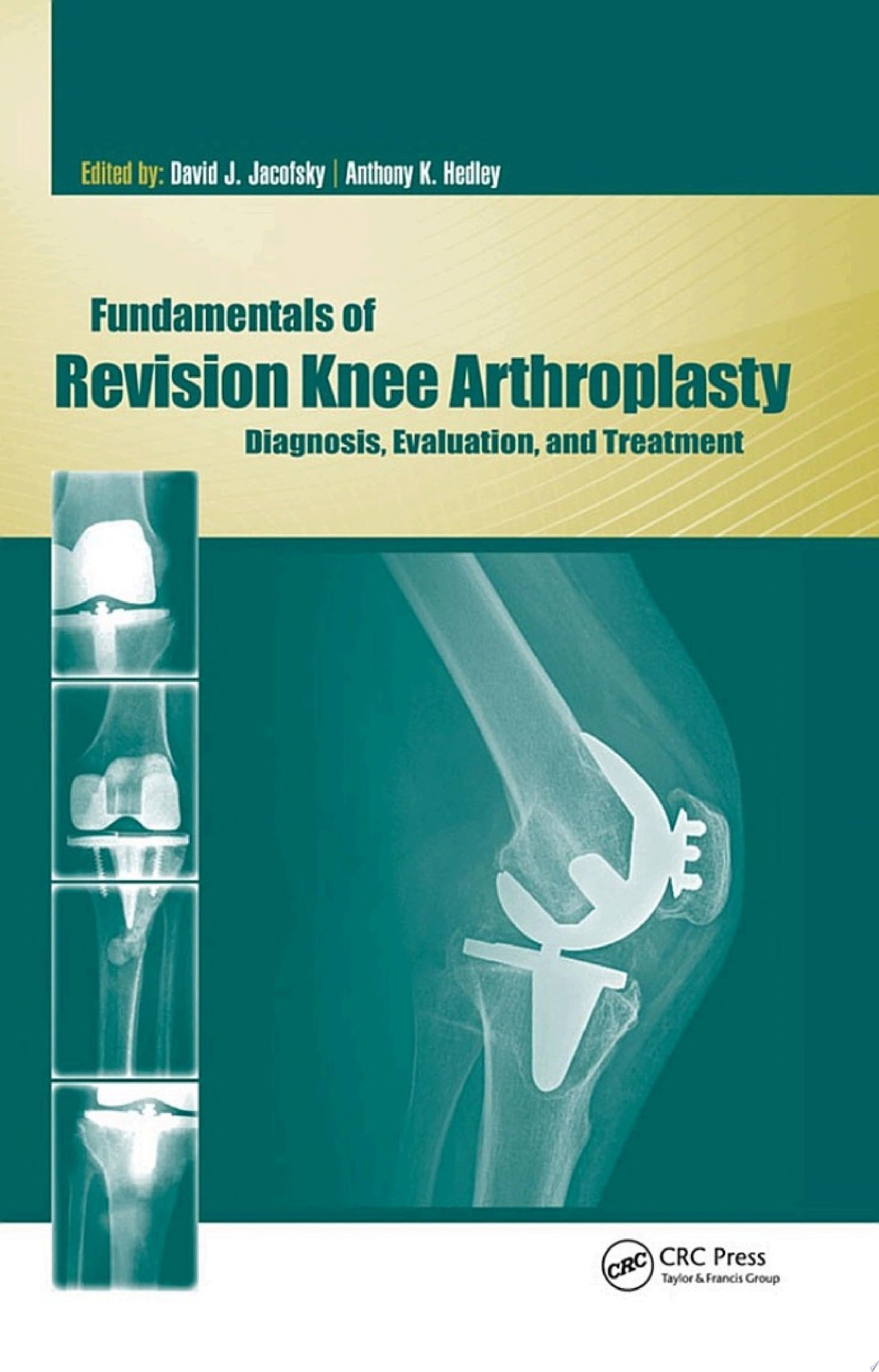 Fundamentals of Revision Knee Arthroplasty: Diagnosis, Evaluation, and Treatment (ORIGINAL PDF from Publisher)