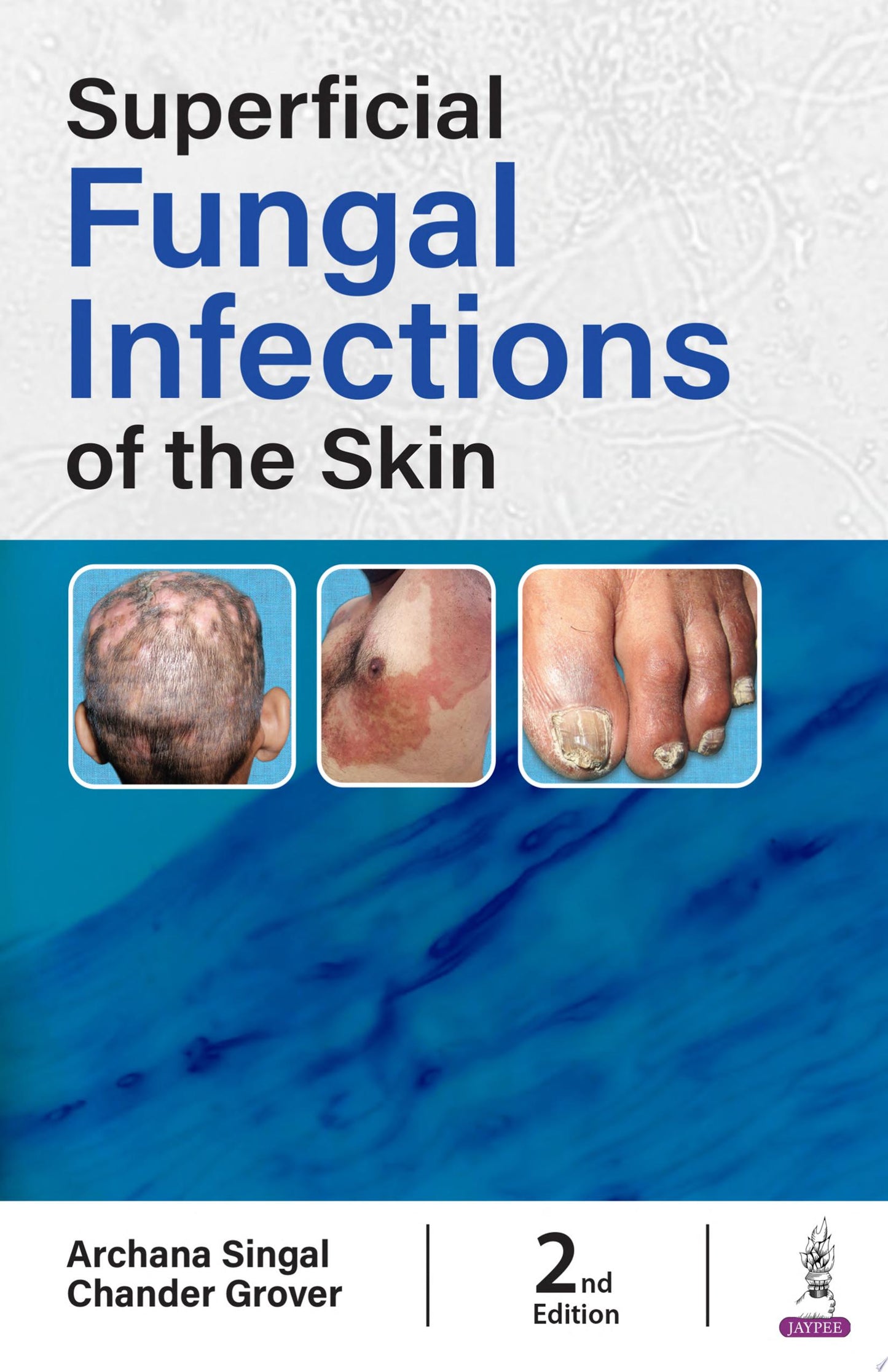 Superficial Fungal Infections of the Skin 2nd Edition