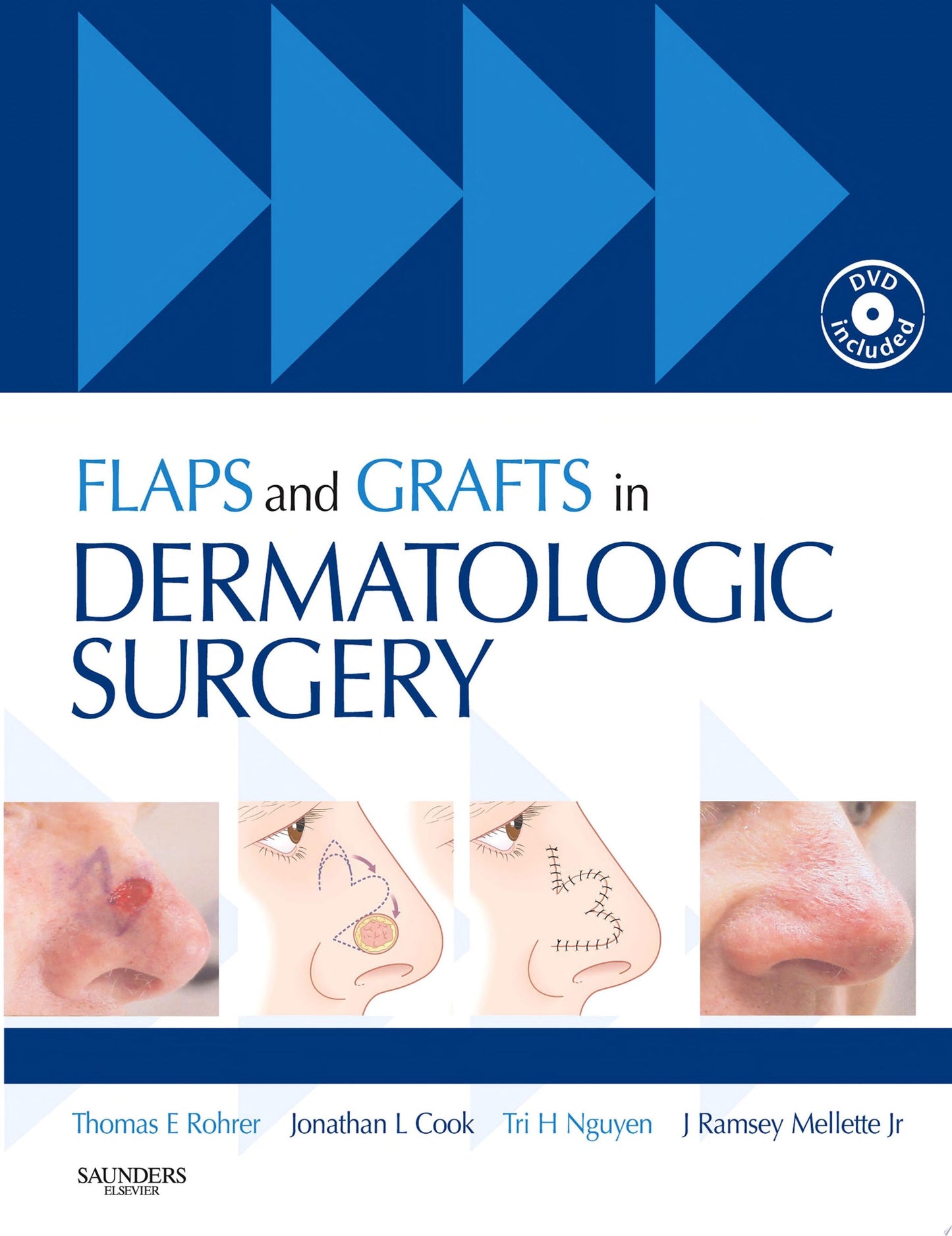 Flaps and Grafts in Dermatologic Surgery E-Book, 1st Edition