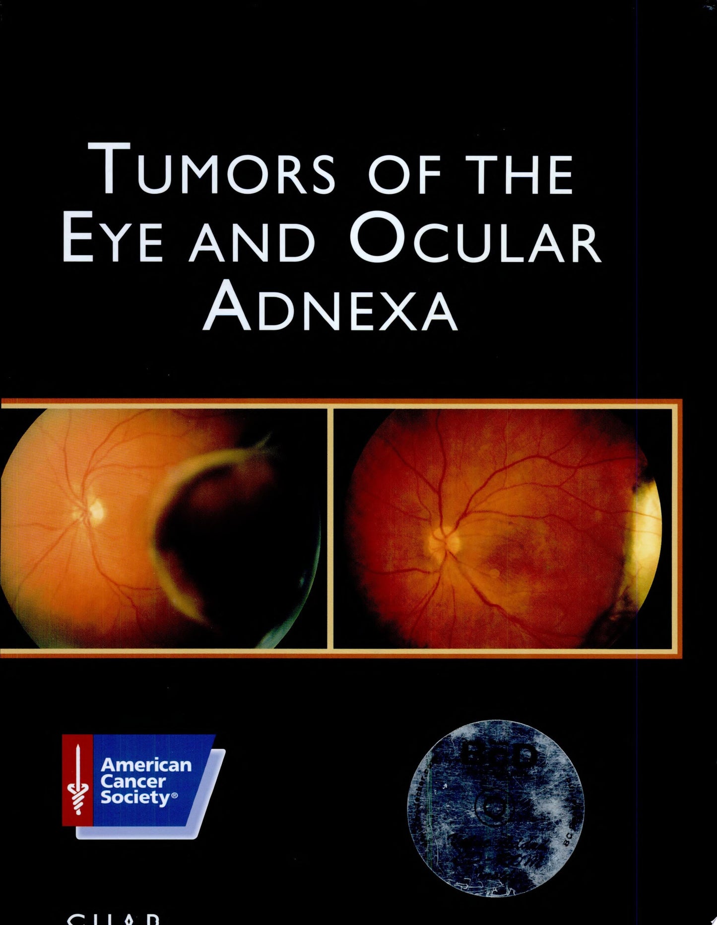 Tumors of the Eye and Ocular Adnexa