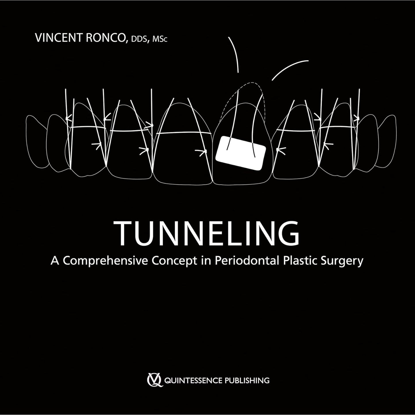 Tunneling: A Comprehensive Concept in Periodontal Plastic Surgery (scanned copy)
