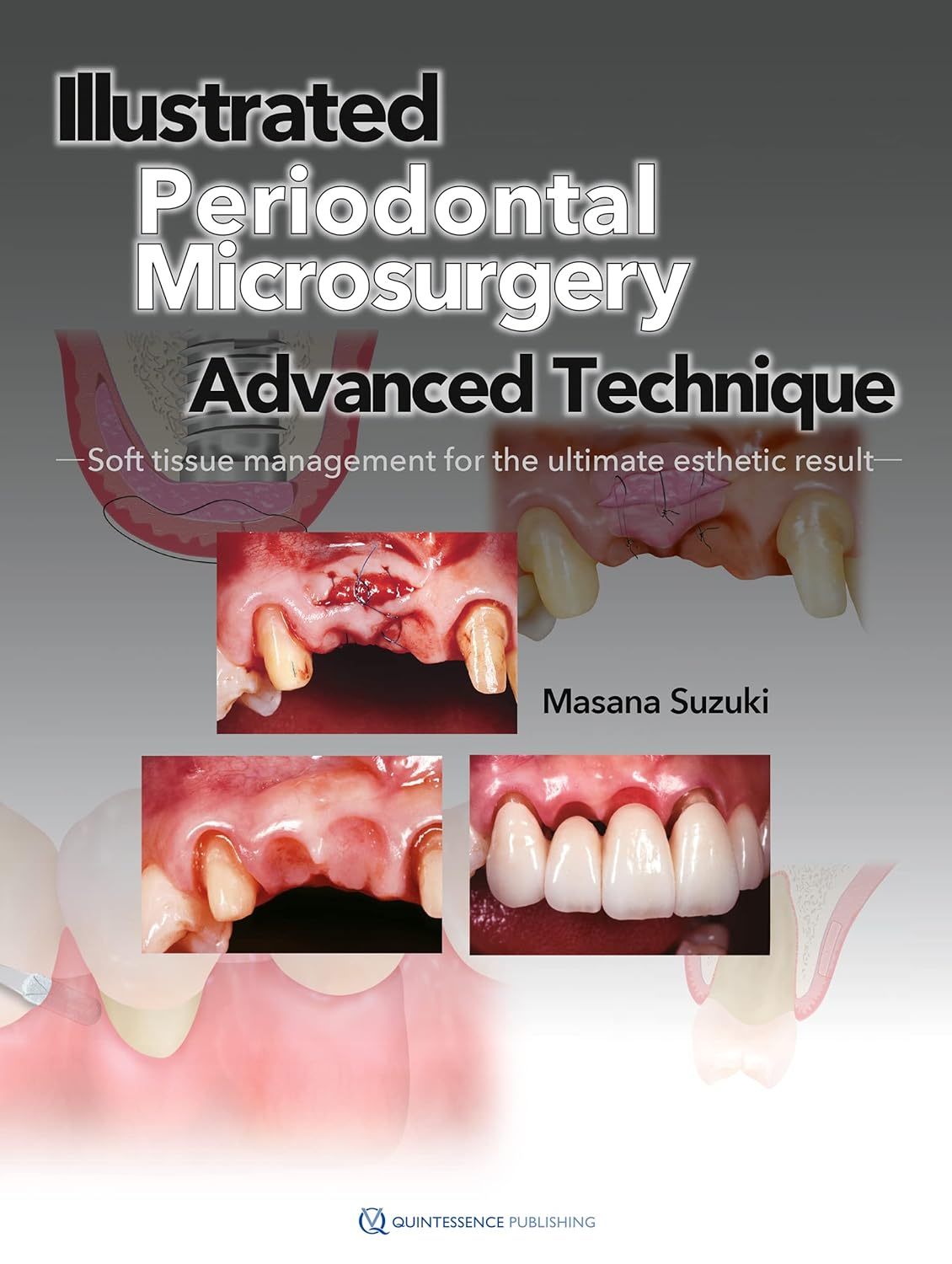 Illustrated Periodontal Microsurgery: Advanced Technique Soft Tissue Management for the Ultimate Esthetic Result