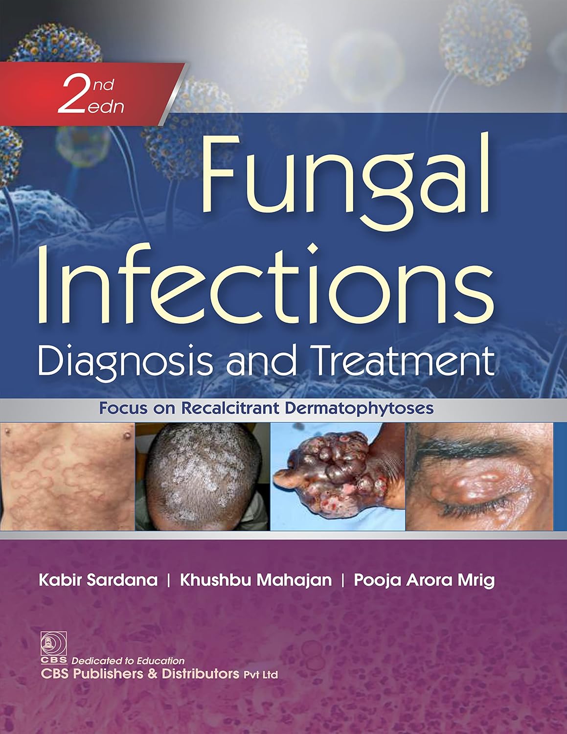 Fungal Infections Diagnosis and Treatment, 2nd edition