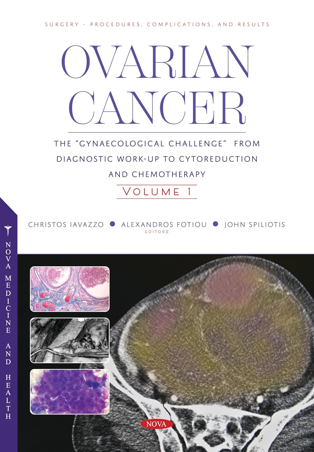 Ovarian Cancer: The Gynaecological Challenge from Diagnostic Work-up to Cytoreduction and Chemotherapy
