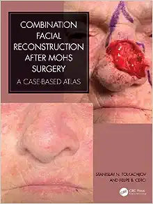 Combination Facial Reconstruction after Mohs Surgery: A Case Based Atlas
