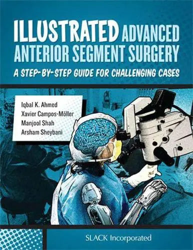 Illustrated Advanced Anterior Segment Surgery: A Step-by-Step Guide for Challenging Cases