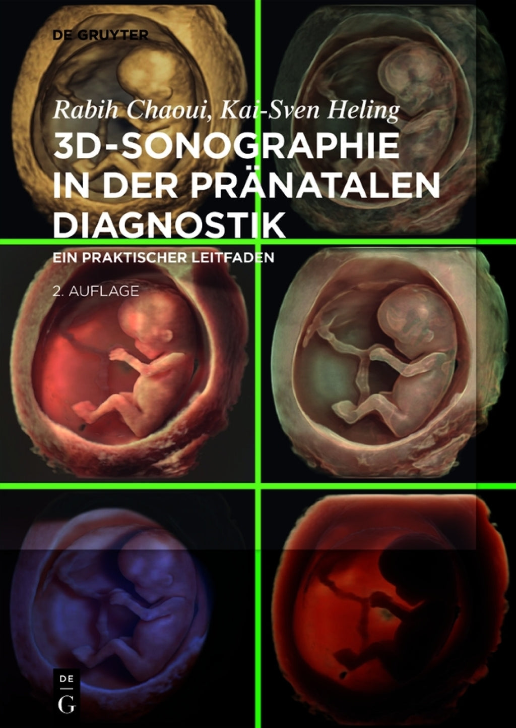 3D-Sonographie in der pränatalen Diagnostik: Ein praktischer Leitfaden, 2nd Edition