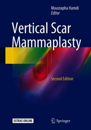 Vertical Scar Mammaplasty, 2nd Edition