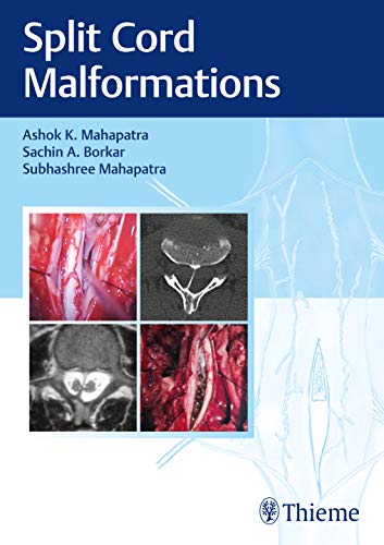 Split Cord Malformations, 2nd edition