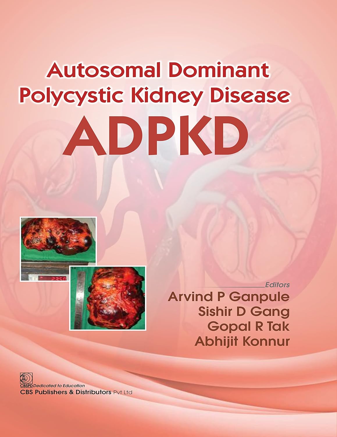 Autosomal Dominant Polytechnic Kidney Disease ADPKD