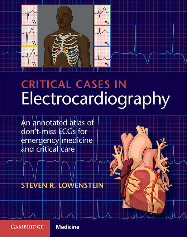 Critical Cases in Electrocardiography: An Annotated Atlas of Don’t-Miss ECGs for Emergency Medicine and Critical Care, 1e
