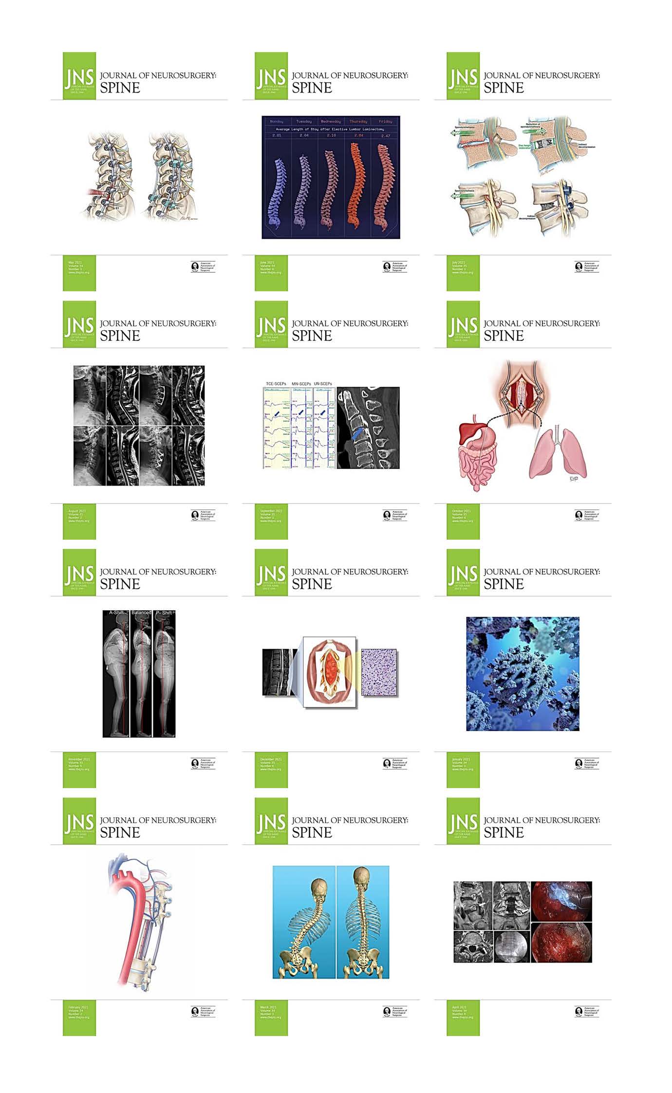 Journal of Neurosurgery: Spine 2021 Full Archives (True PDF)