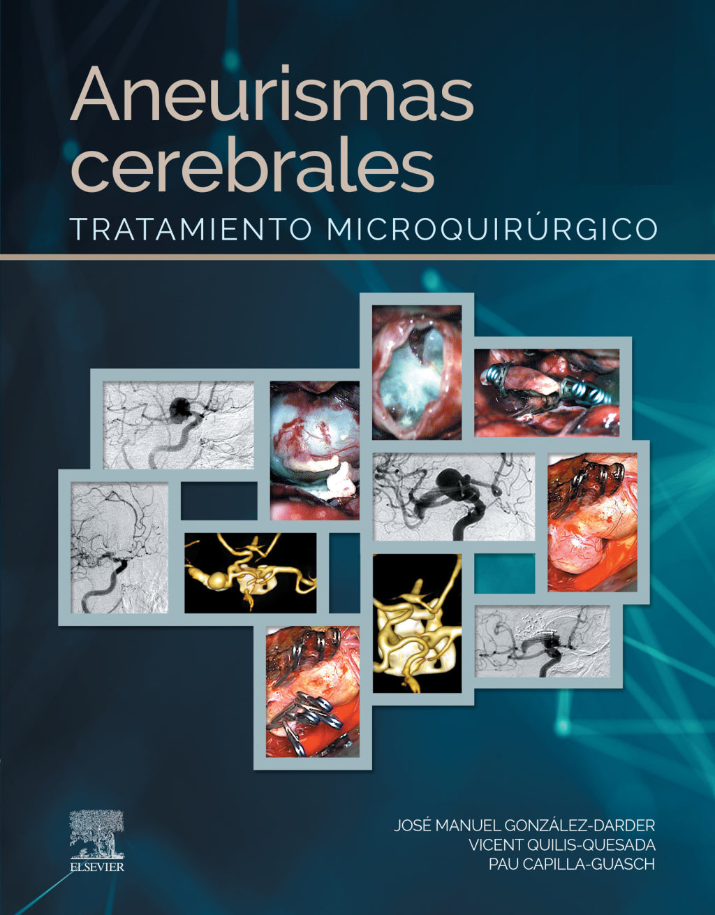 Aneurismas cerebrales: Tratamiento microquirúrgico