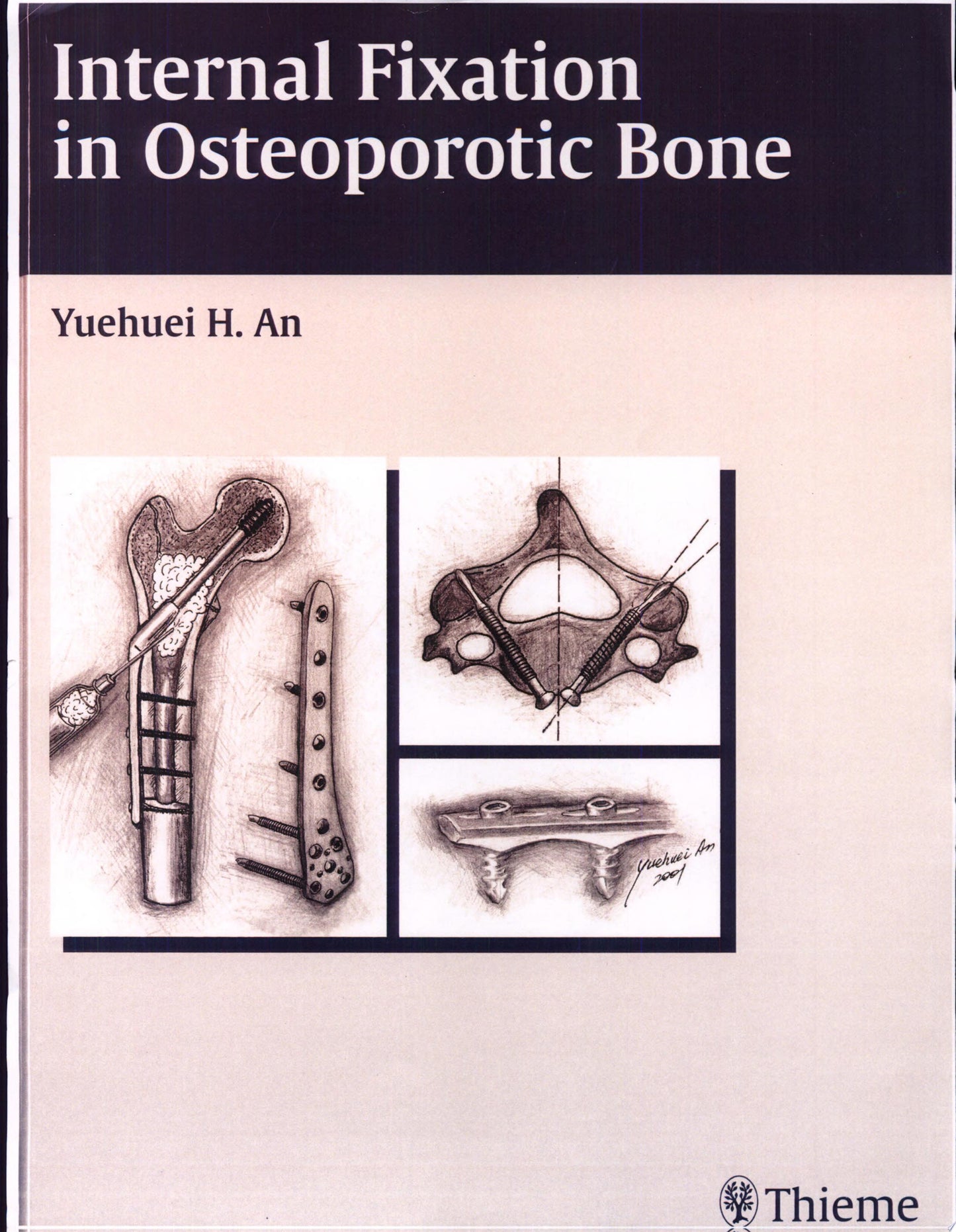 Internal Fixation in Osteoporotic Bone