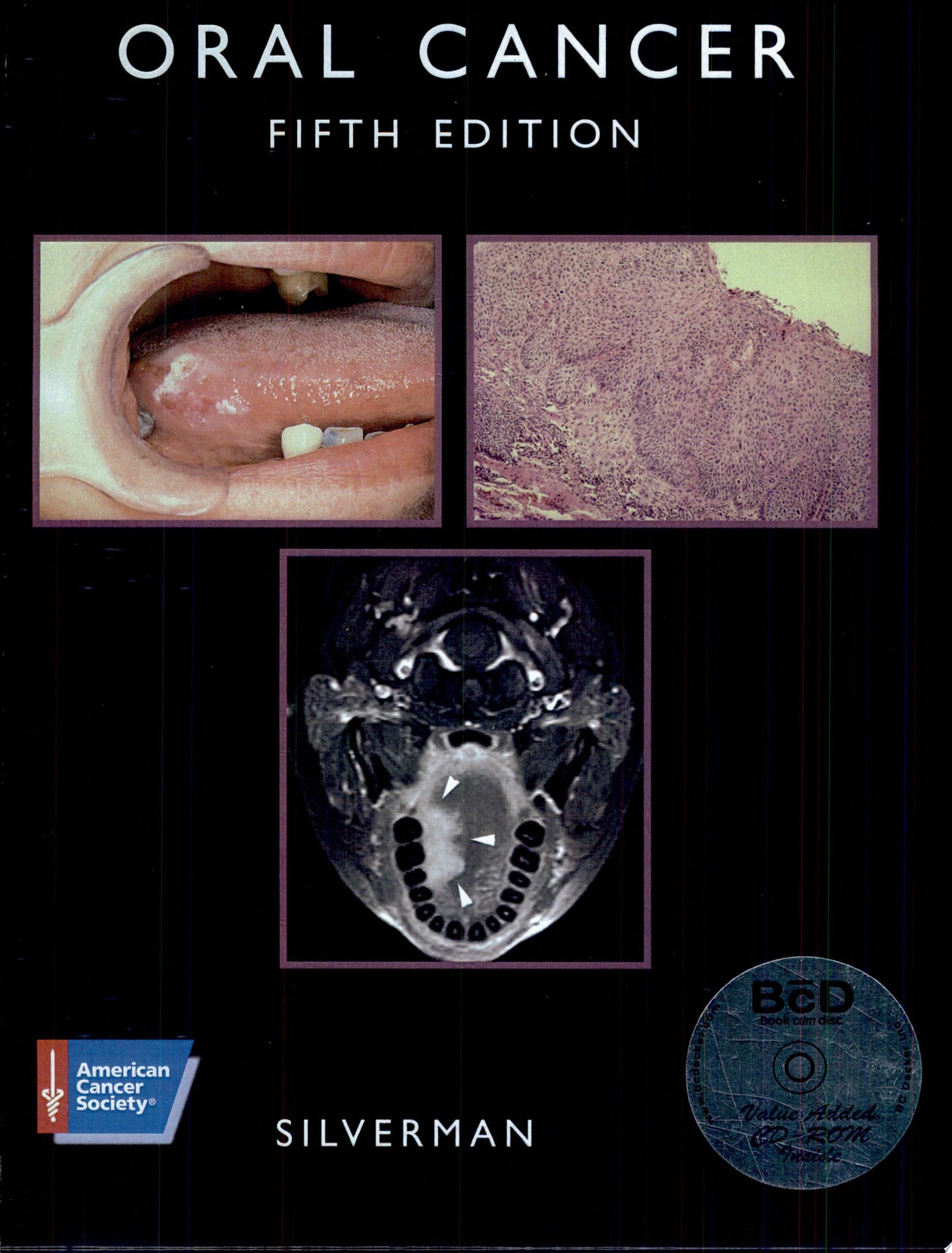 Oral Cancer