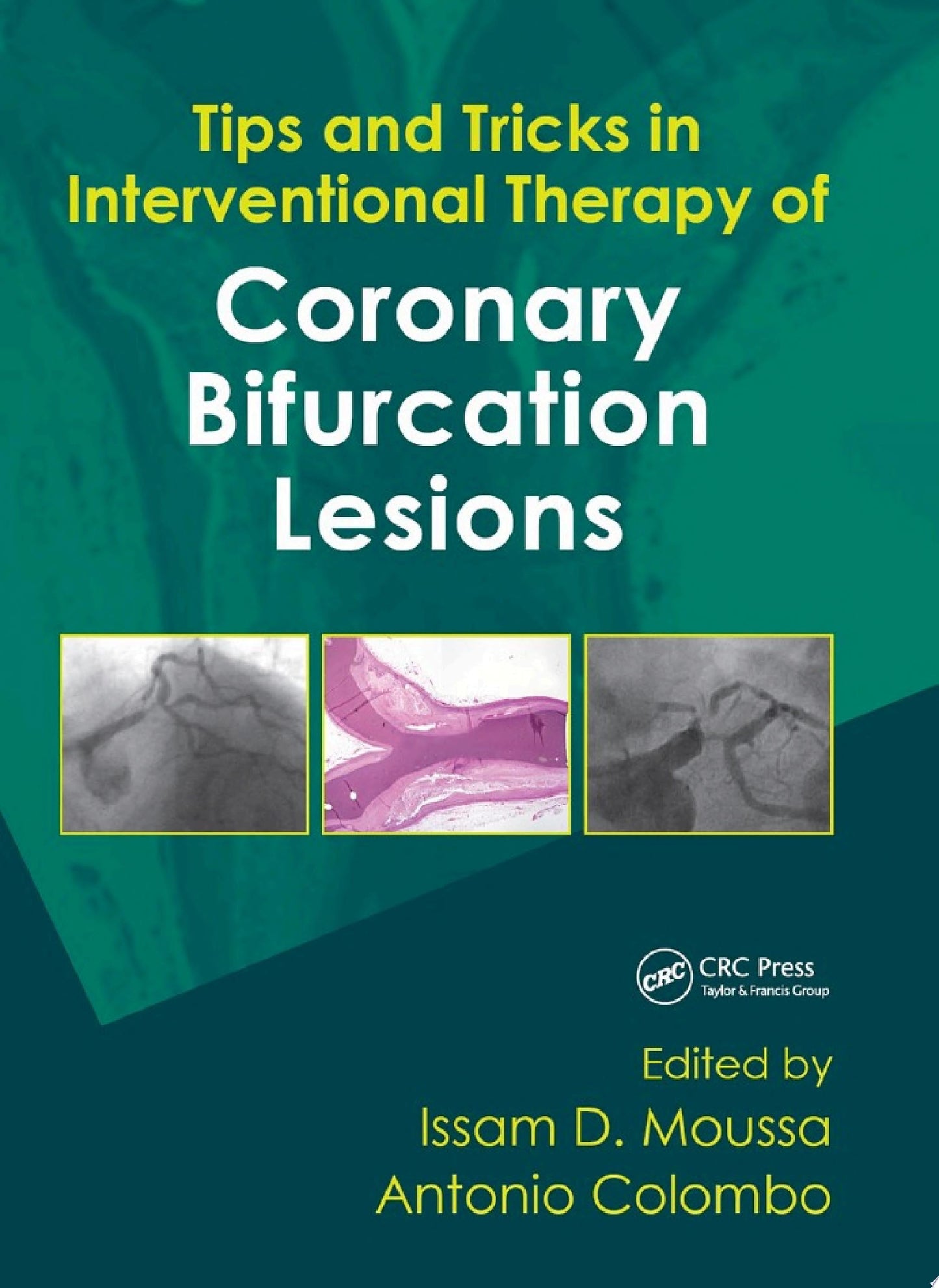 Tips and Tricks in Interventional Therapy of Coronary Bifurcation Lesions