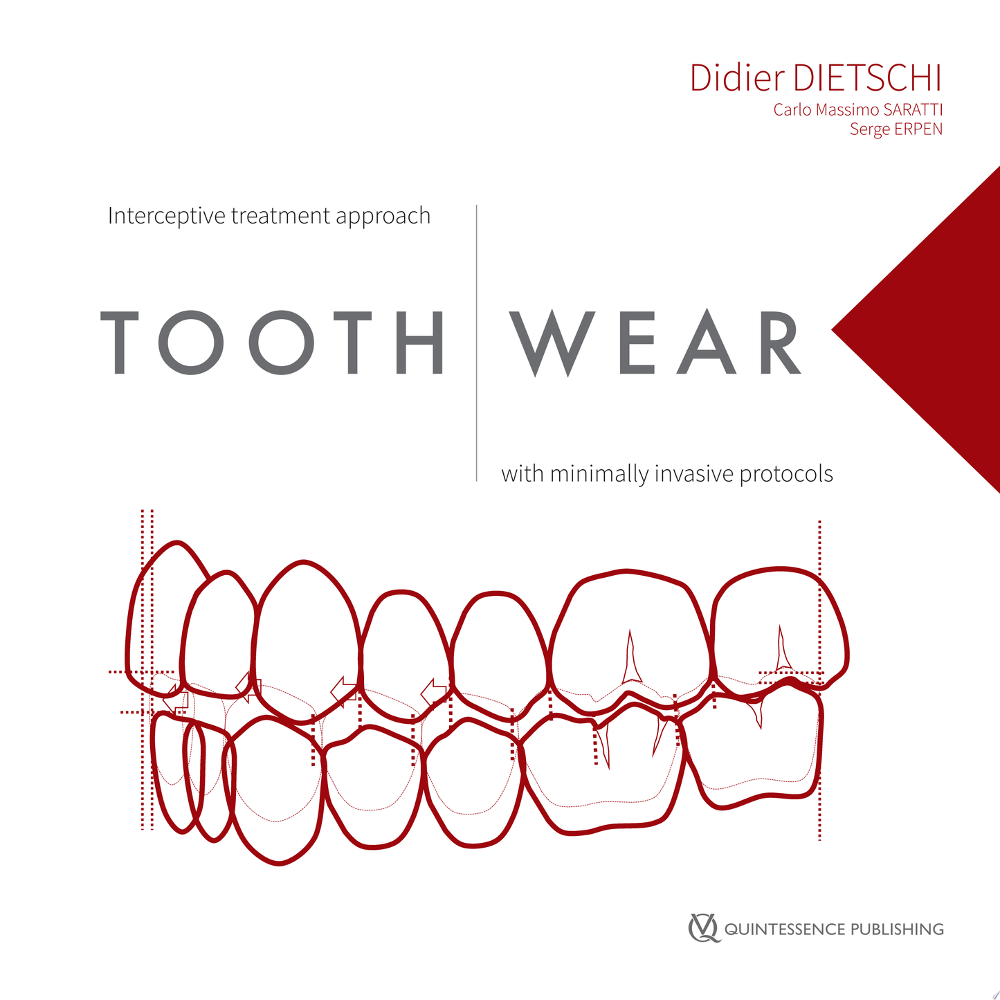 Tooth Wear