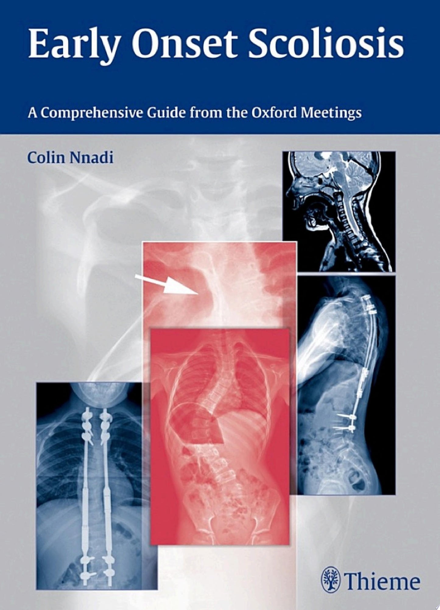 The ASSI Monographs: Early Onset Scoliosis