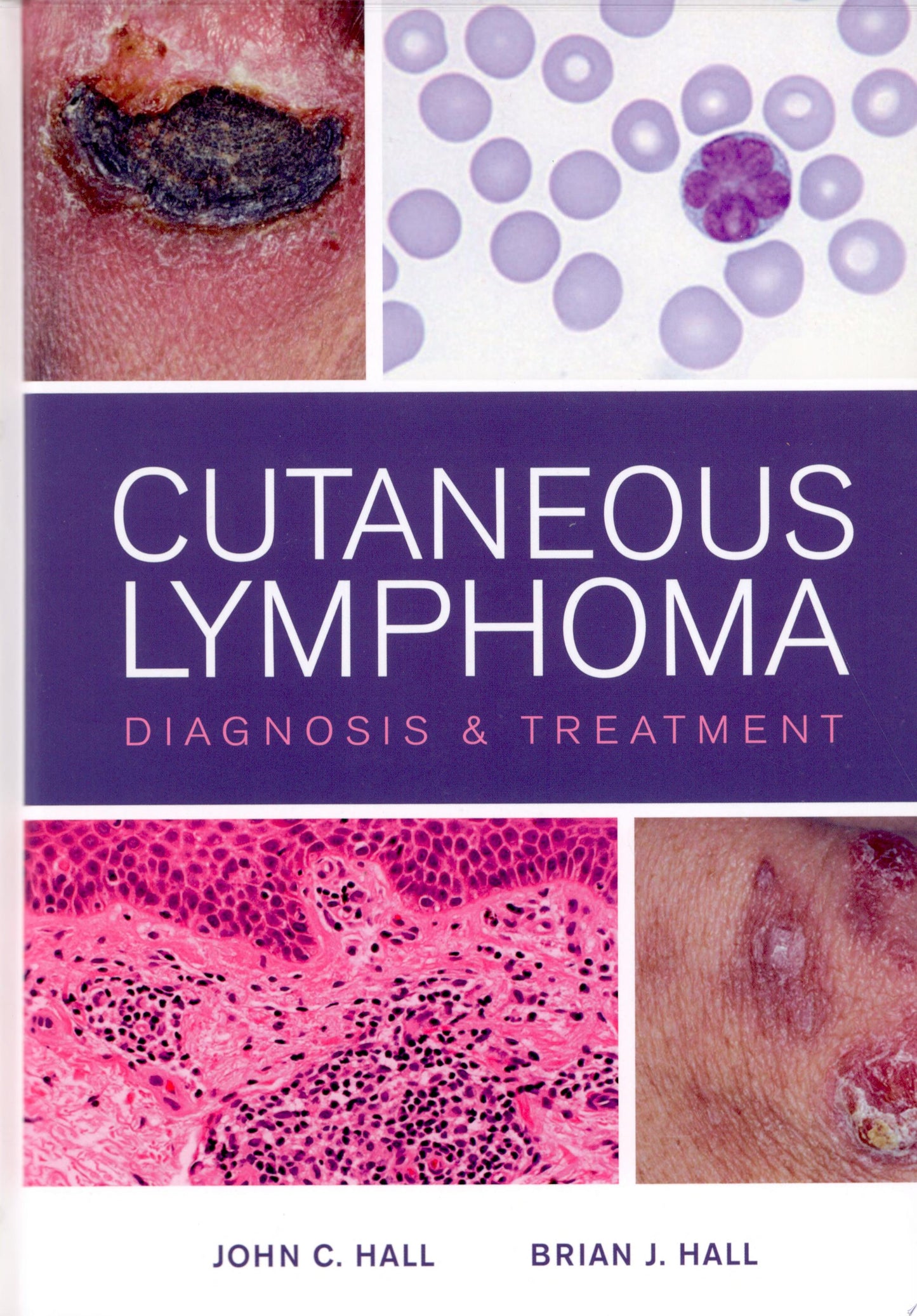 Cutaneous Lymphoma : Diagnosis and Treatment