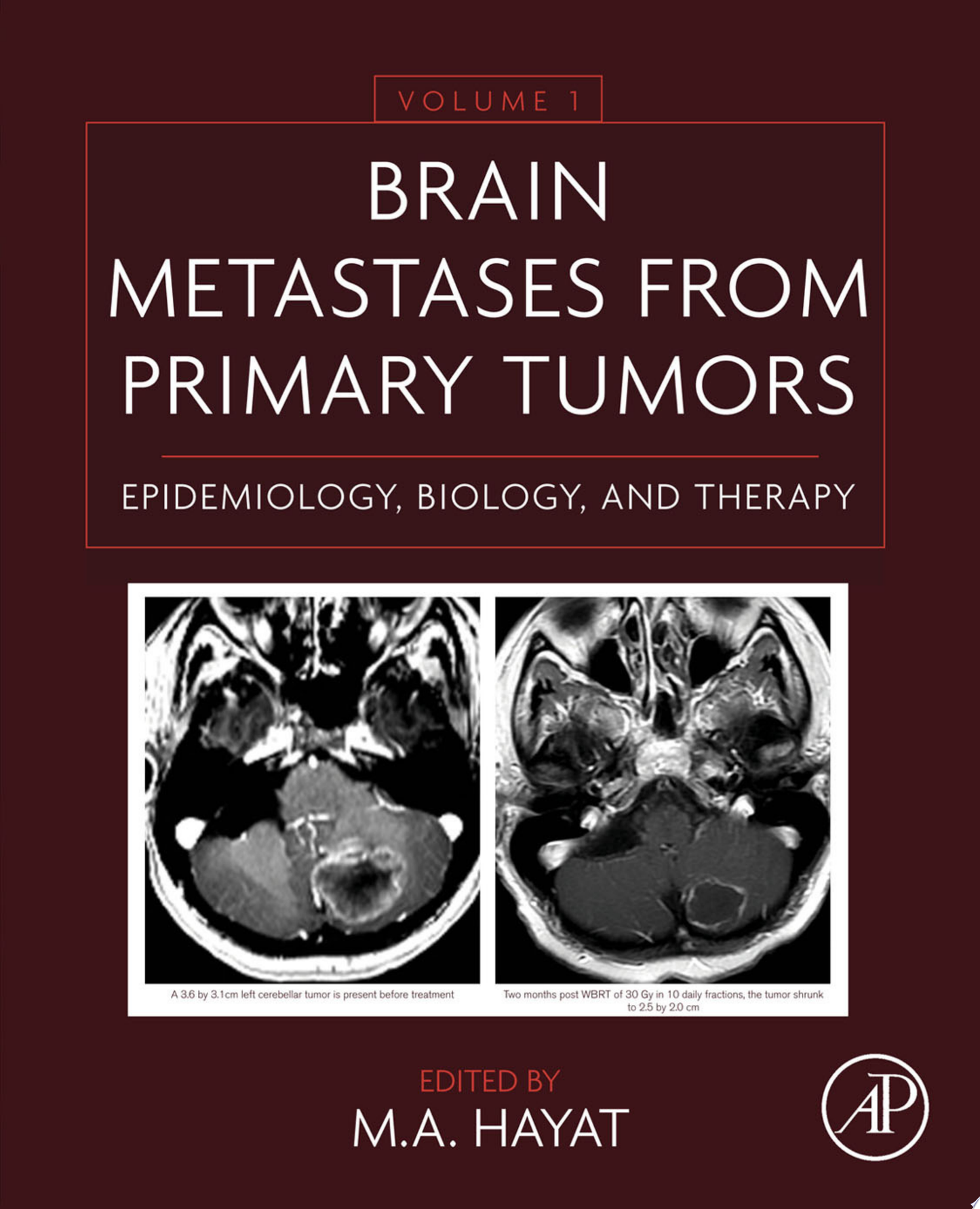 Brain Metastases from Primary Tumors, Volume 1: Epidemiology, Biology, and Therapy