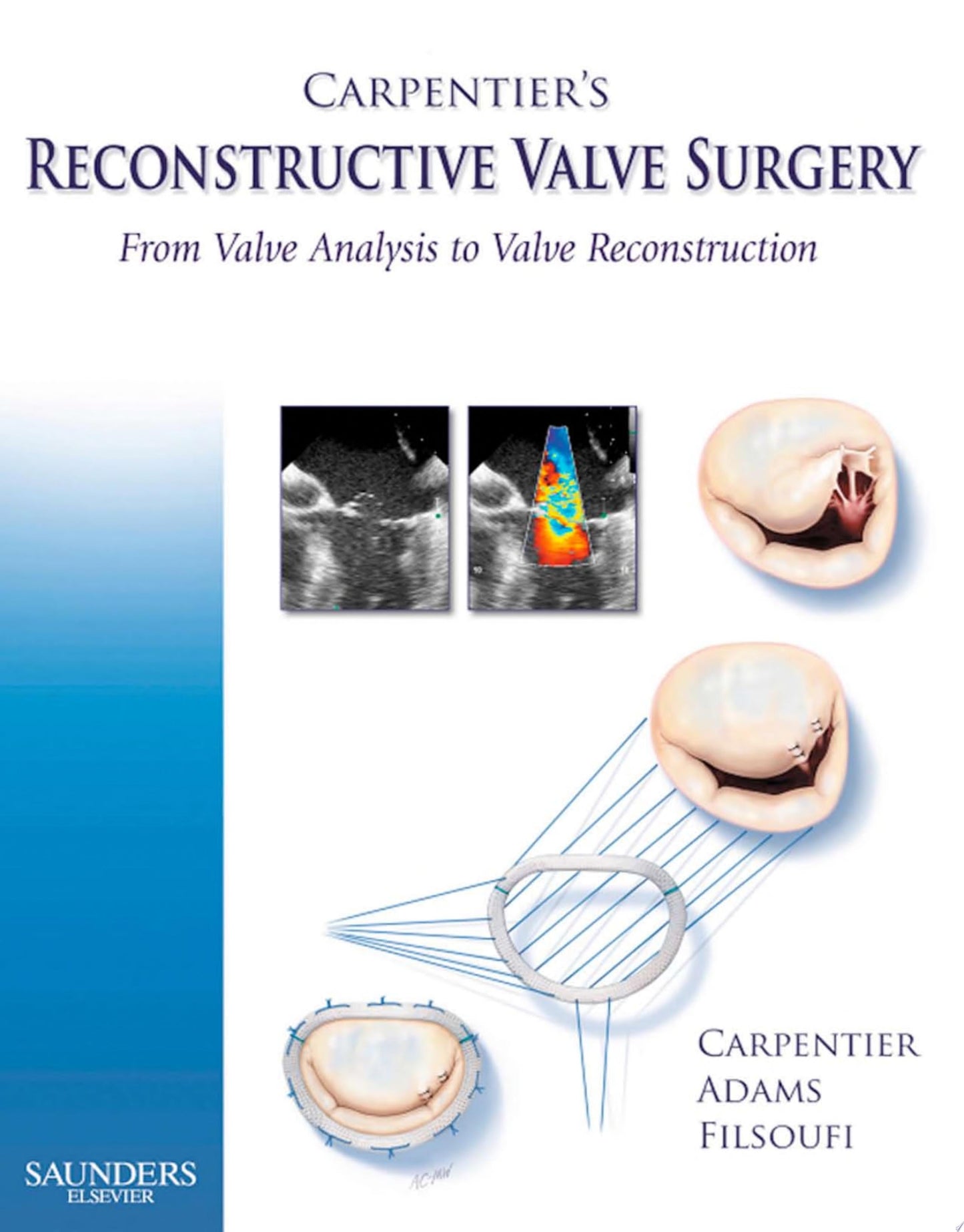 Carpentier’s Reconstructive Valve Surgery, 1e