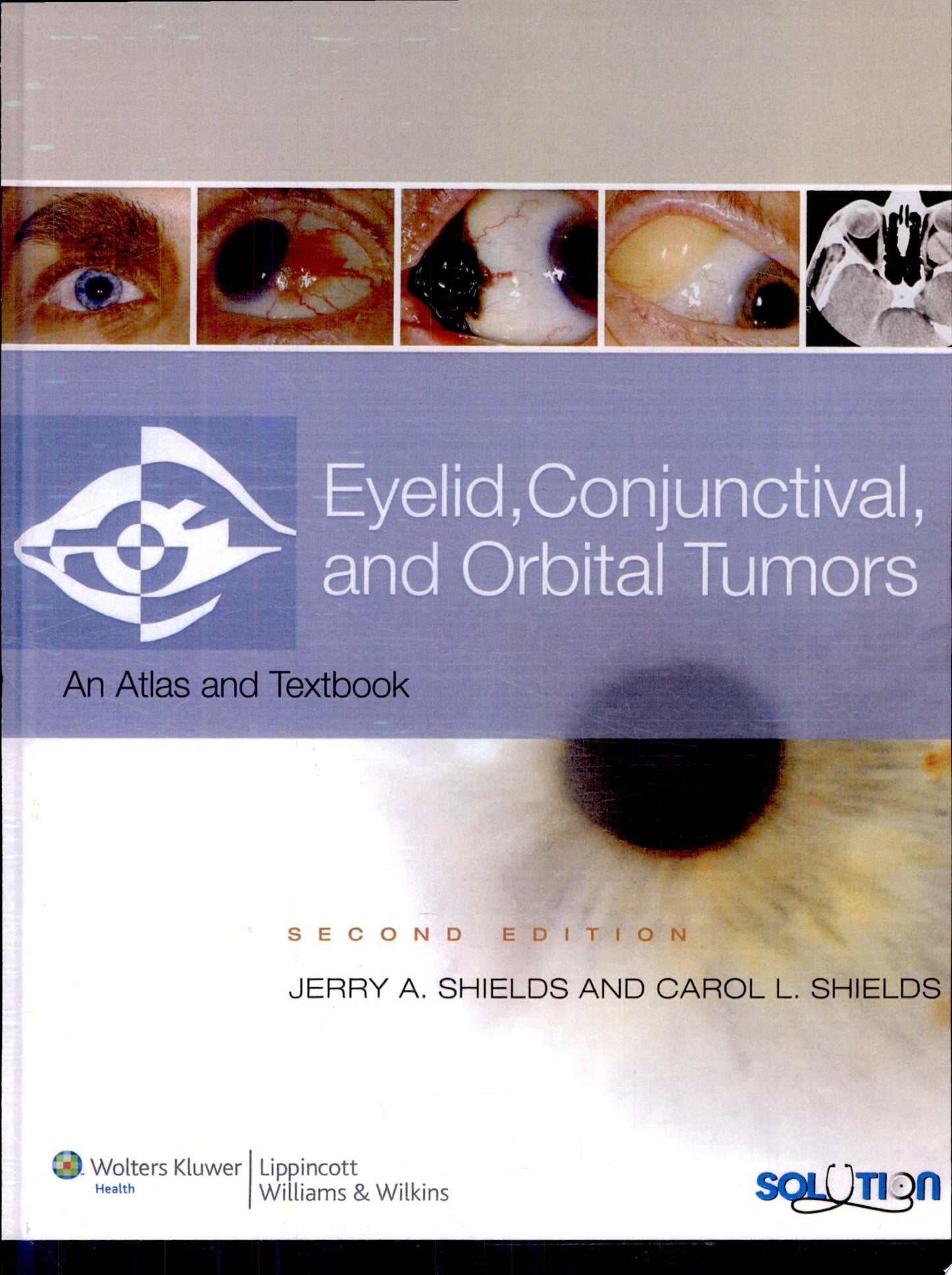 Eyelid, Conjunctival, and Orbital Tumors and Intraocular Tumors: An Atlas and Text, 2nd Edition