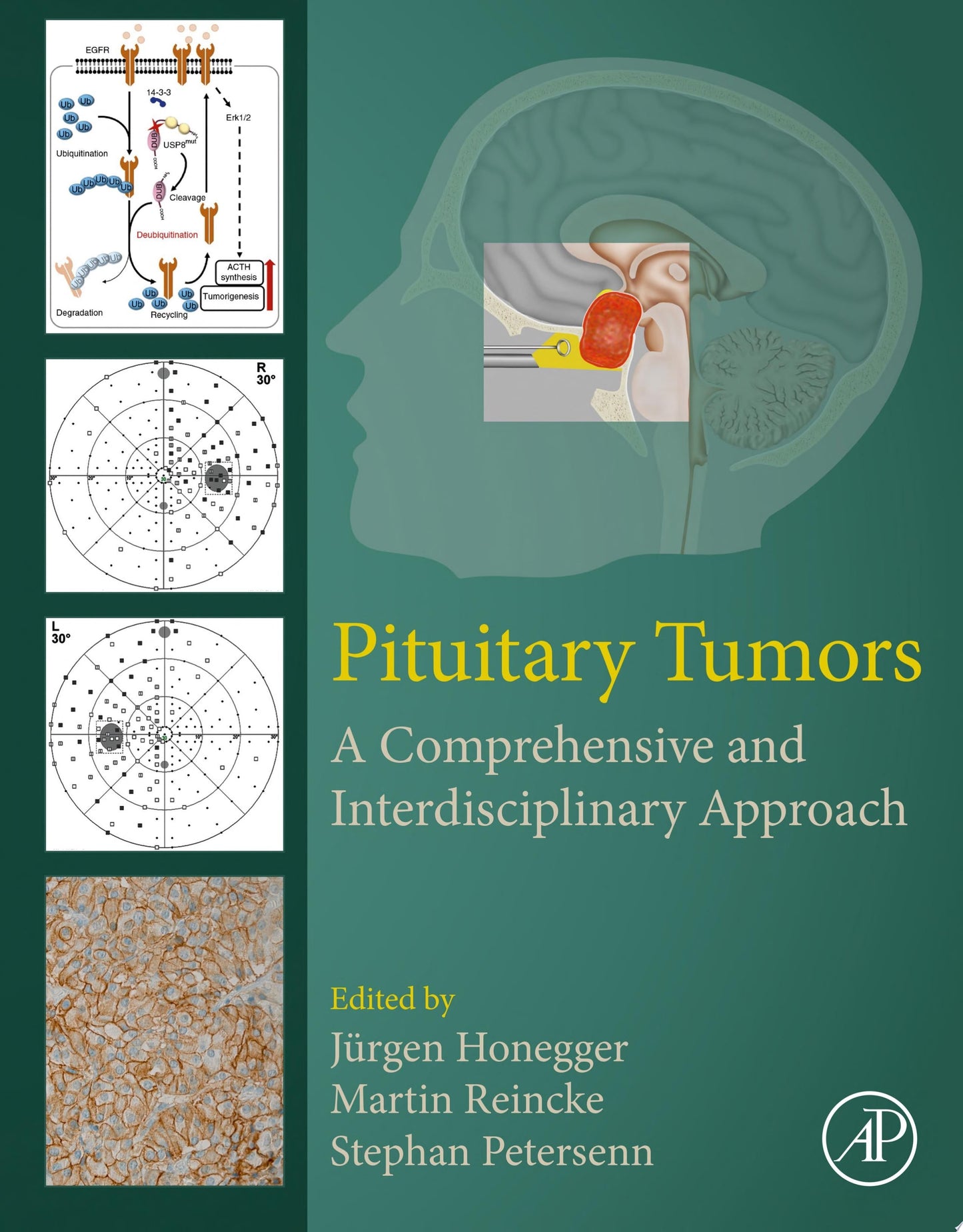 Pituitary Tumors: A Comprehensive and Interdisciplinary Approach