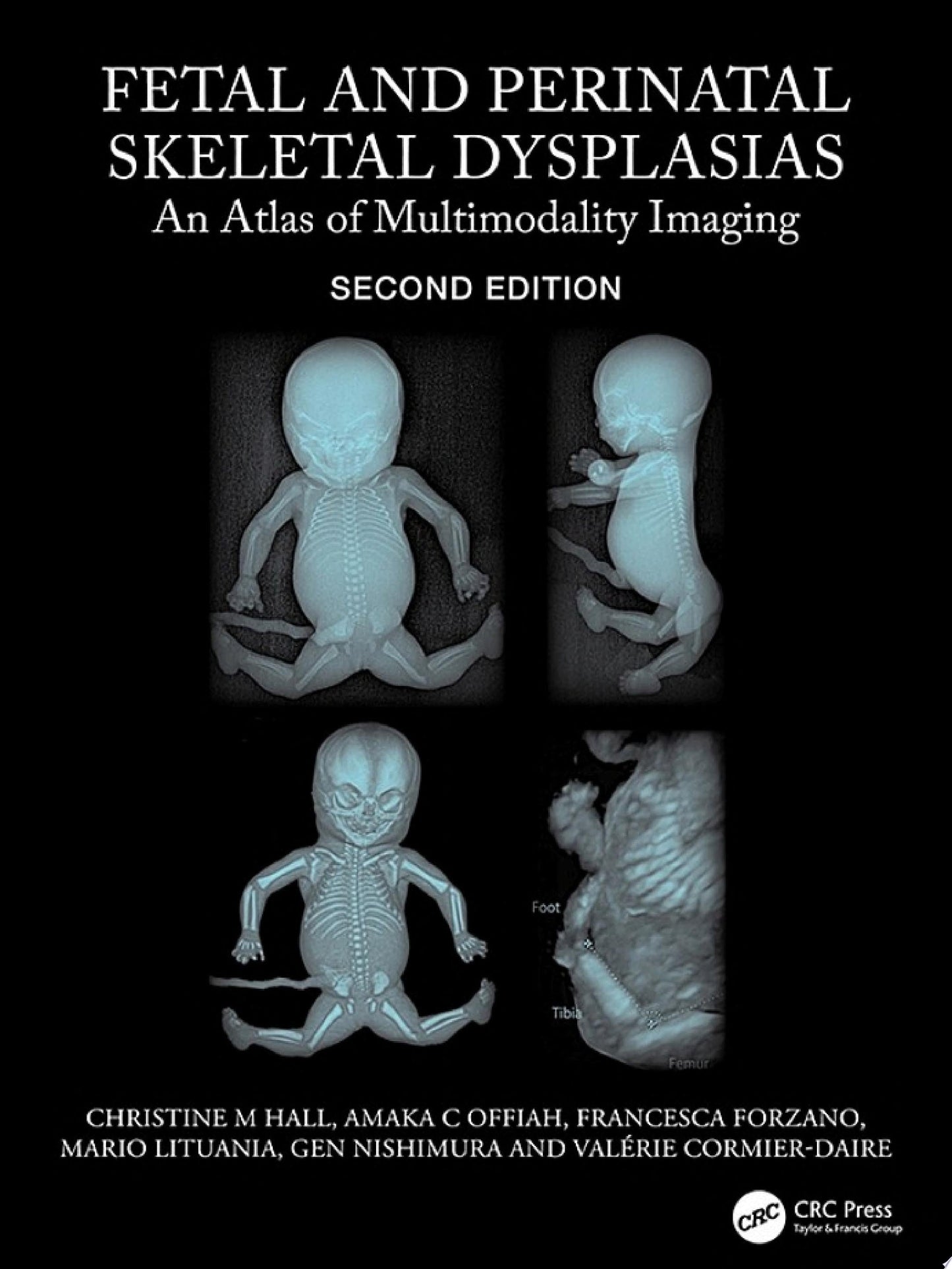 Fetal and Perinatal Skeletal Dysplasias: An Atlas of Multimodality Imaging, 2nd Edition