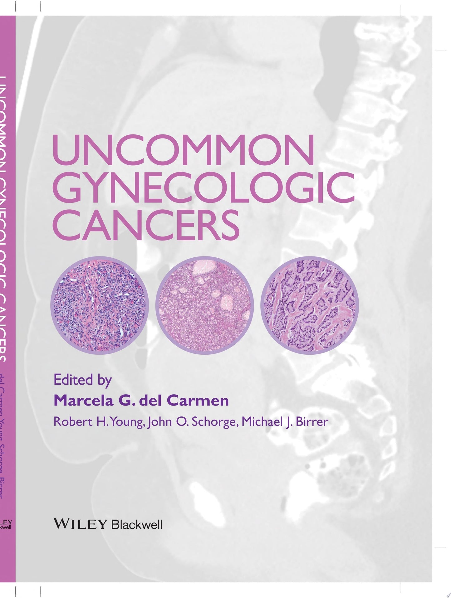 Uncommon Gynecologic Cancers